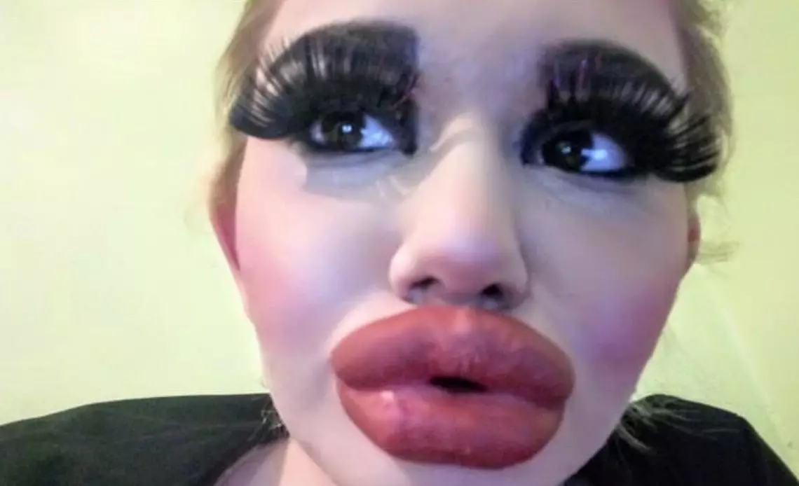 large lips, lip fillers