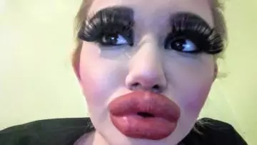 Largest lips in the world - Andrea Ivanova gets 20 fillers in her lips, this is what she looks like 😱🤯